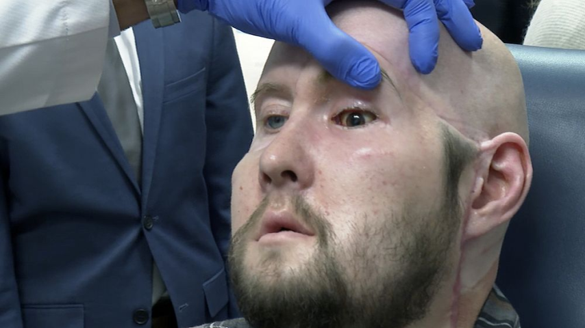 جراحون يعلنون إجراء أول عملية زرع عين كاملة في العالم