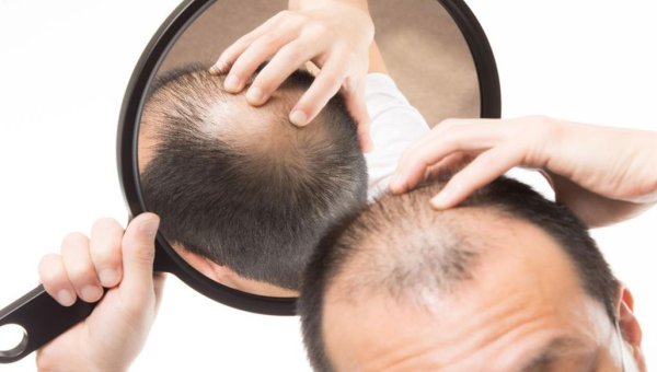 دراسة جديدة.. هذه المشروبات تؤدي إلى تساقط الشعر عند الرجال